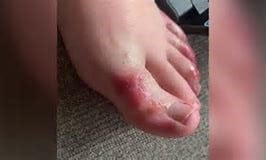 coronavirus foot symptom